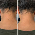 AyuSure Mukti | Skin Tag Remover Oil